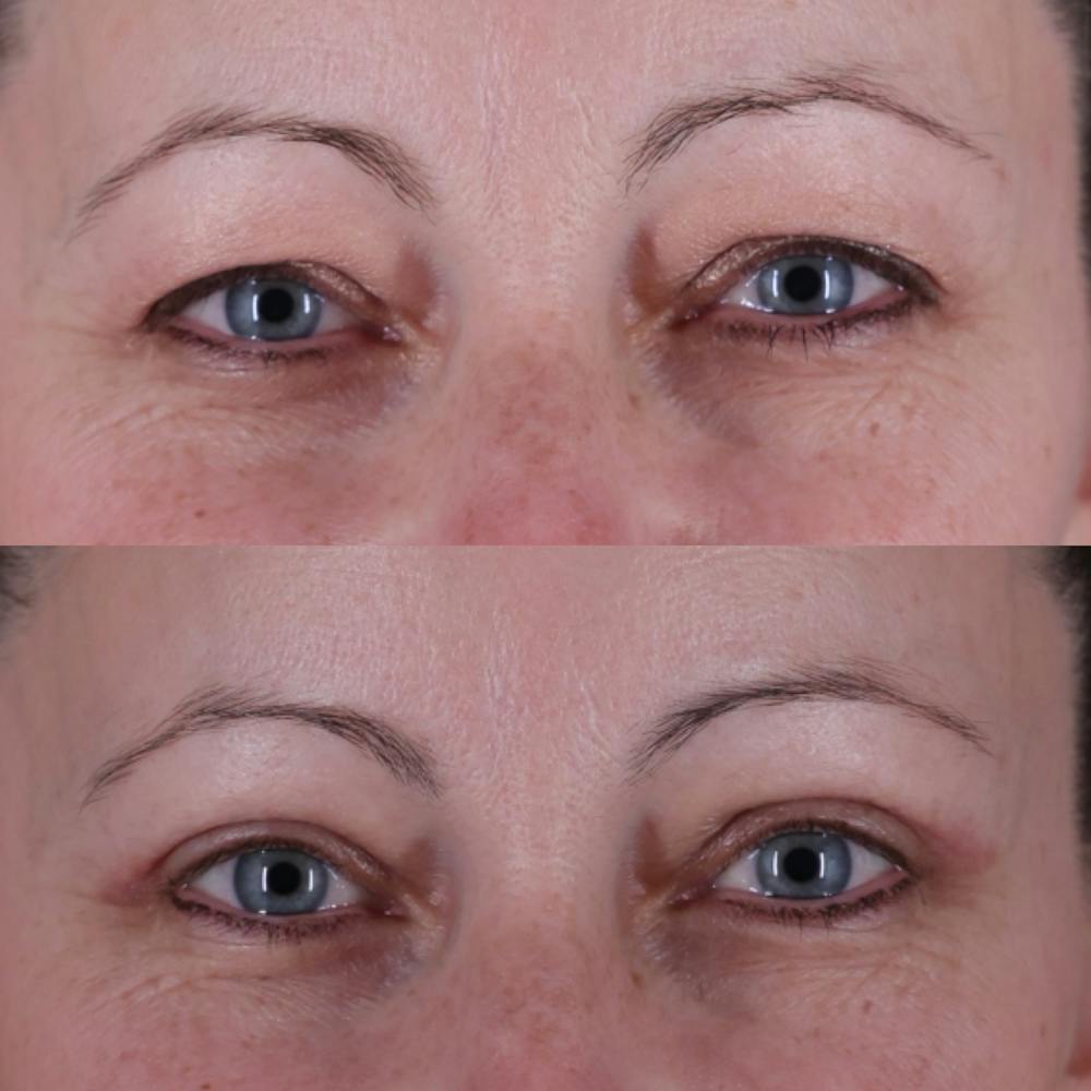 Upper Blepharoplasty Before & After Gallery - Patient 198681 - Image 1
