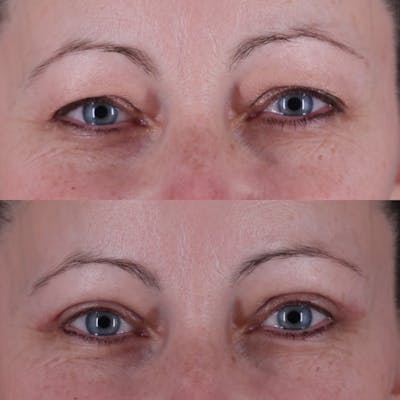 Upper Blepharoplasty Before & After Gallery - Patient 198681 - Image 1