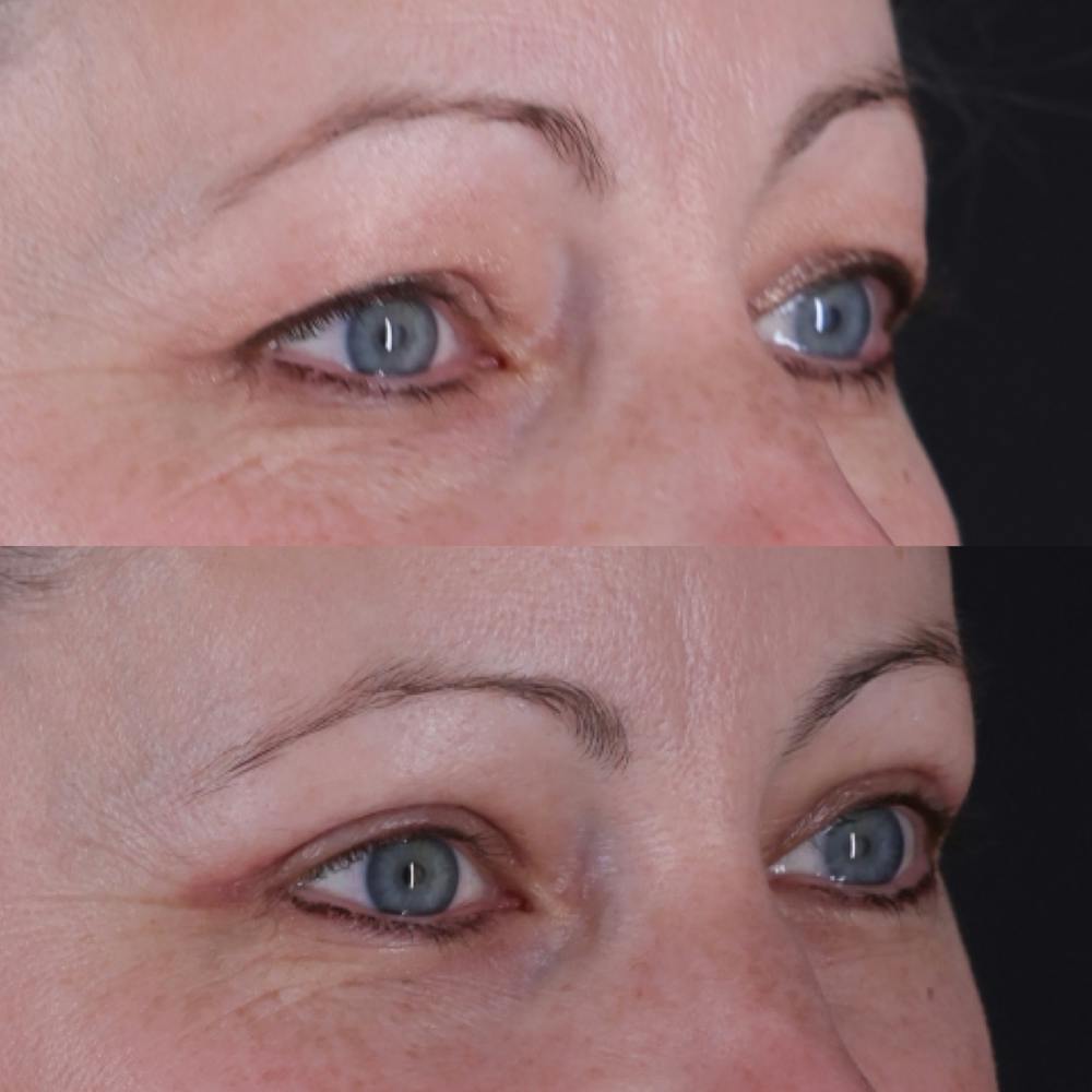 Upper Blepharoplasty Before & After Gallery - Patient 198681 - Image 2