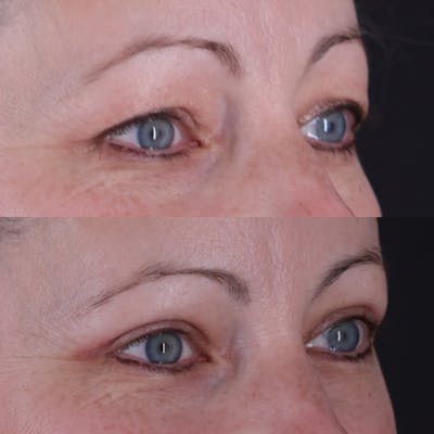 Upper Blepharoplasty Before & After Gallery - Patient 198681 - Image 2