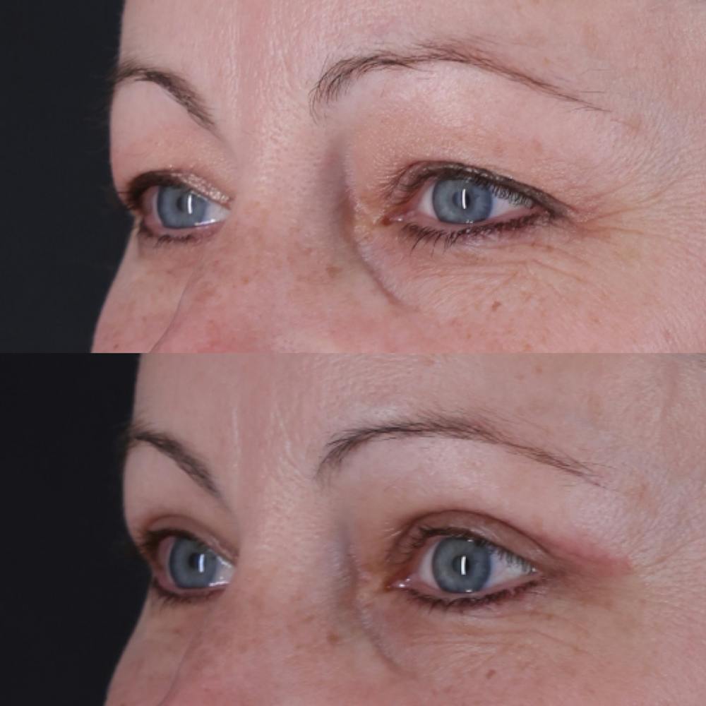 Upper Blepharoplasty Before & After Gallery - Patient 198681 - Image 3