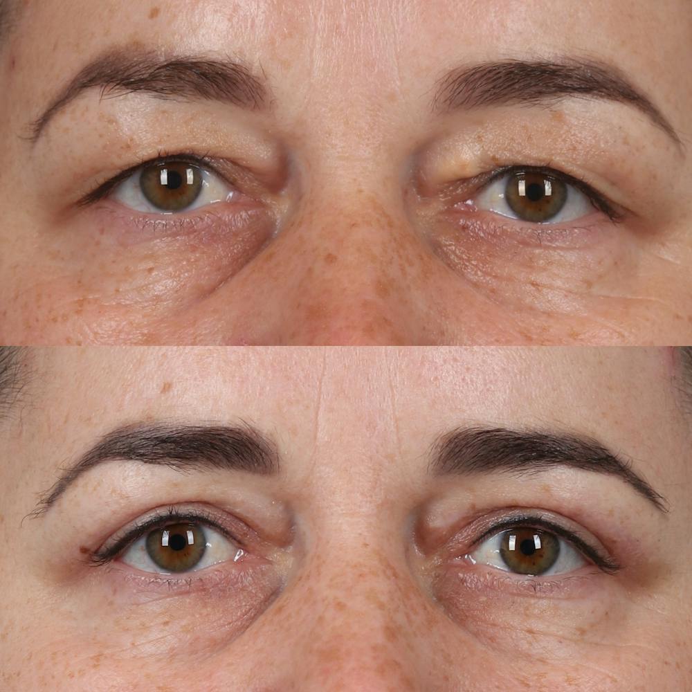 Upper Blepharoplasty Before & After Gallery - Patient 555602 - Image 1