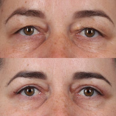 Upper Blepharoplasty Before & After Gallery - Patient 555602 - Image 1
