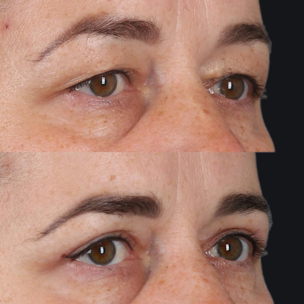Upper Blepharoplasty Before & After Gallery - Patient 555602 - Image 2