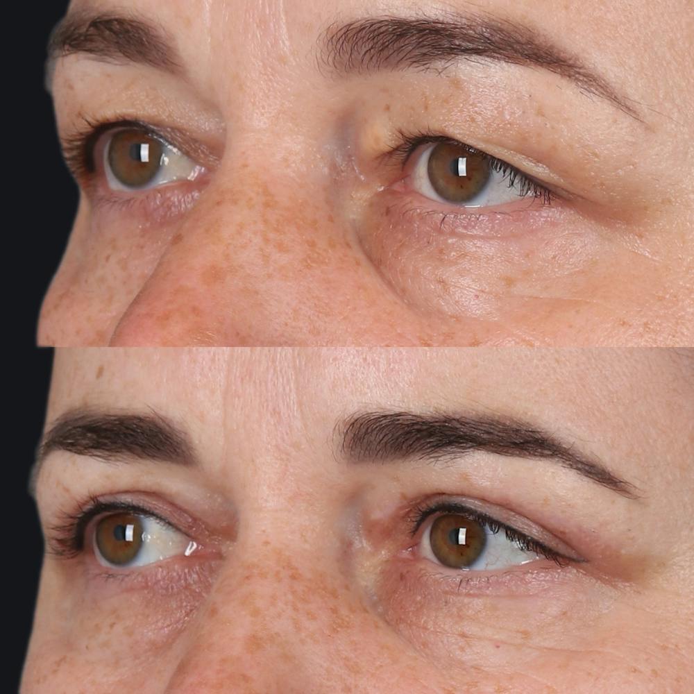 Upper Blepharoplasty Before & After Gallery - Patient 555602 - Image 3