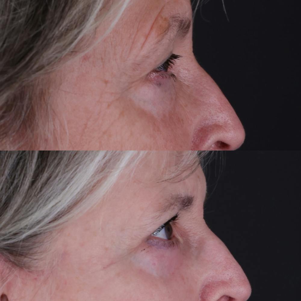Upper Blepharoplasty Before & After Gallery - Patient 404763 - Image 3