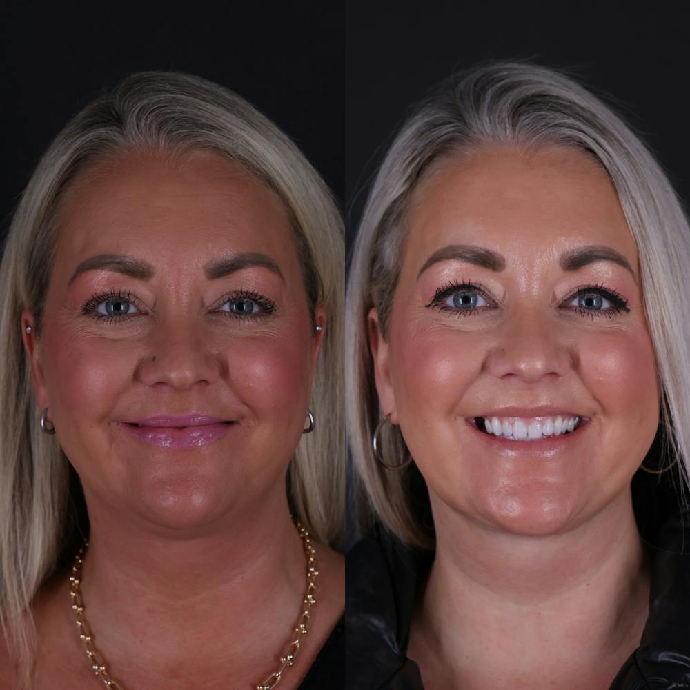 Deep Neck Lift Before & After Gallery - Patient 256522 - Image 4