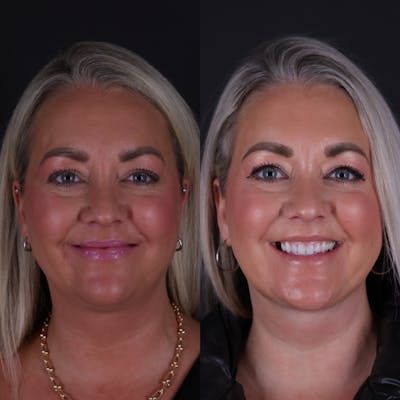 Deep Neck Lift Before & After Gallery - Patient 256522 - Image 4