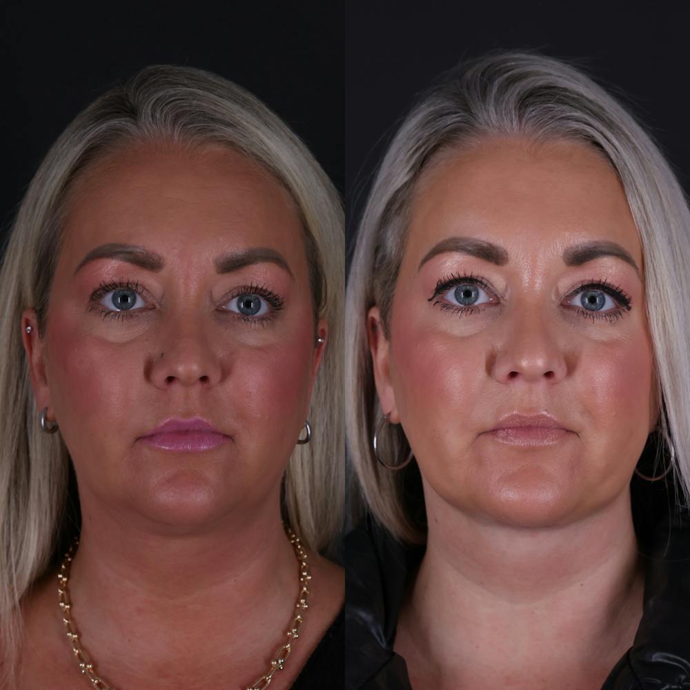 Deep Neck Lift Before & After Gallery - Patient 256522 - Image 2