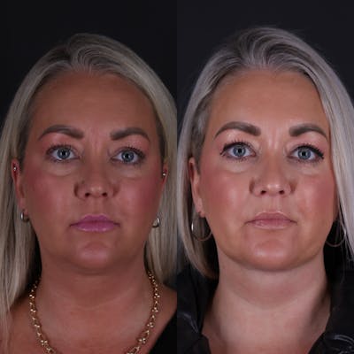 Deep Neck Lift Before & After Gallery - Patient 256522 - Image 2