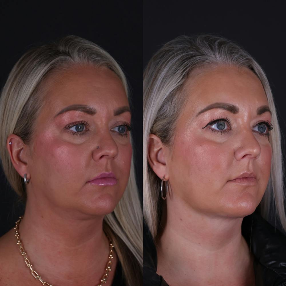 Deep Neck Lift Before & After Gallery - Patient 256522 - Image 3