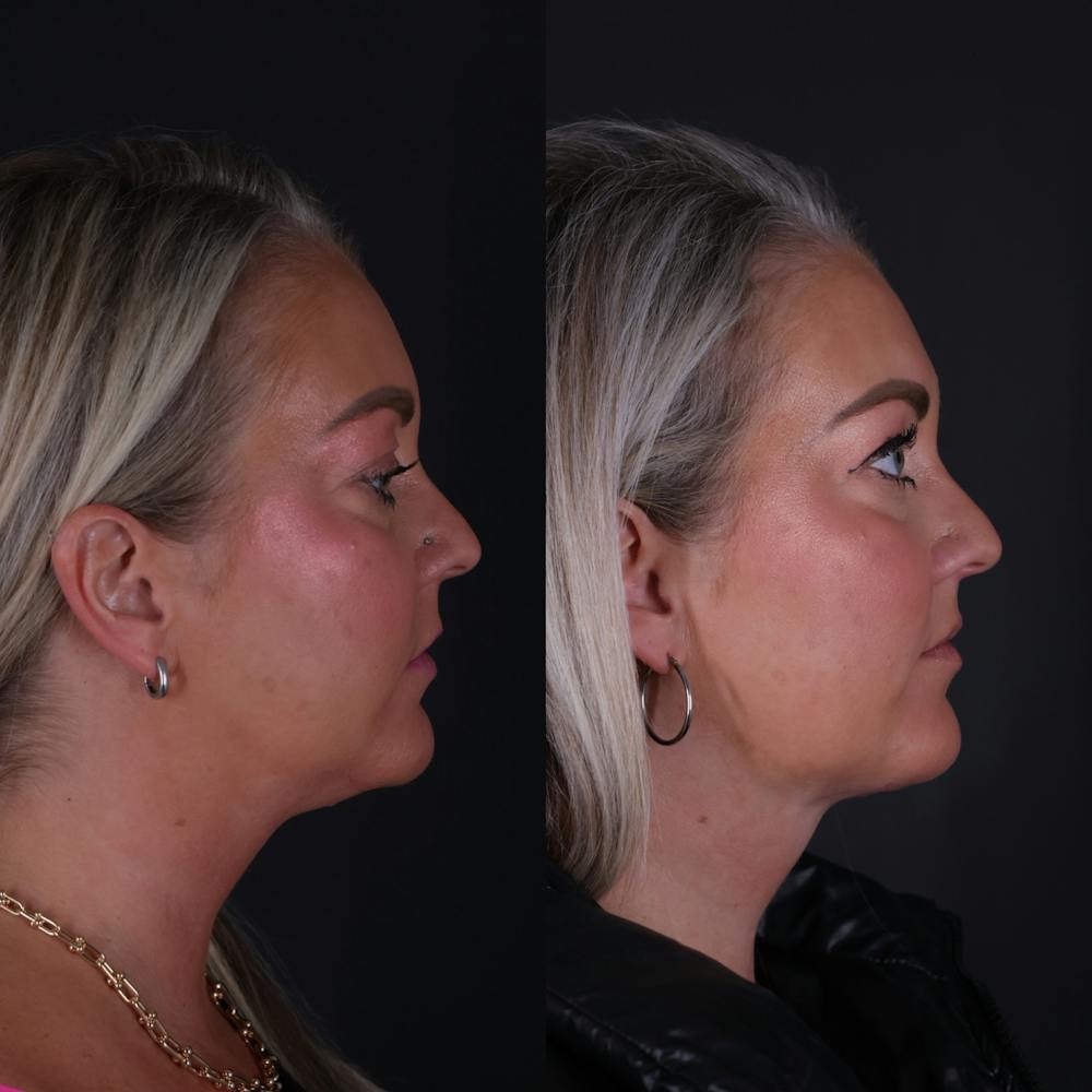 Deep Neck Lift Before & After Gallery - Patient 256522 - Image 1