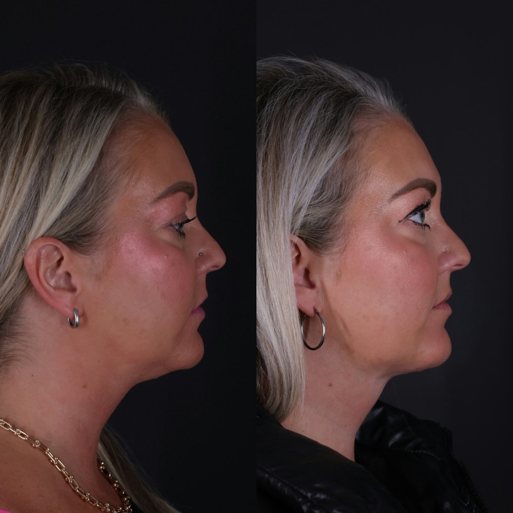 Neck Lift in Portland Before & After Photos