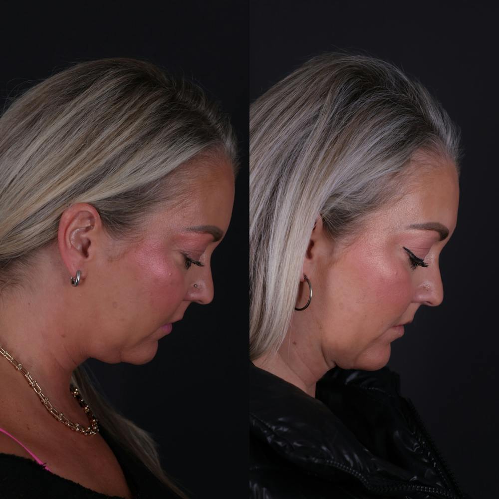 Deep Neck Lift Before & After Gallery - Patient 256522 - Image 5