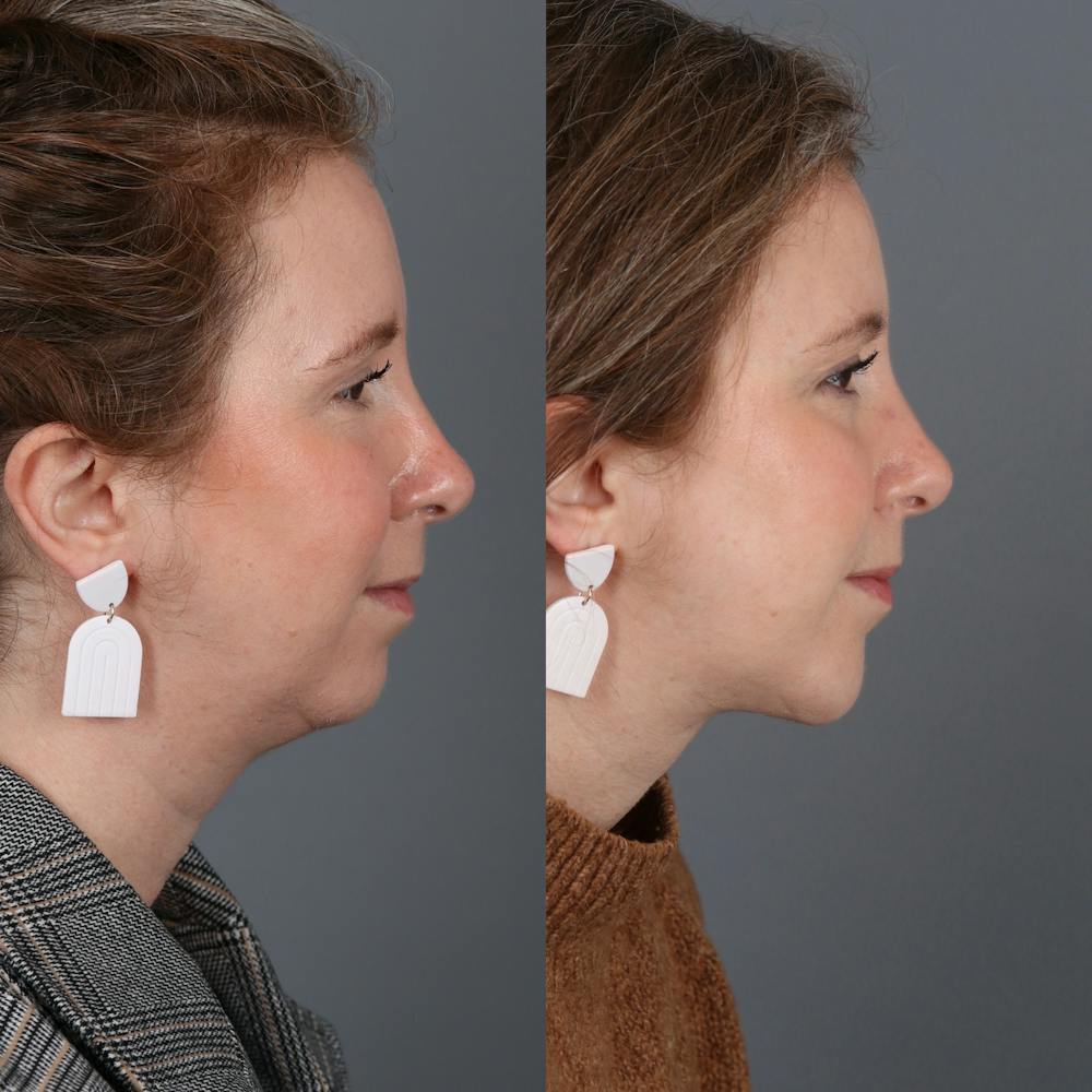 Deep Neck Lift Before & After Gallery - Patient 377524 - Image 1