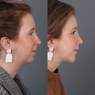 Deep Neck Lift Before & After Gallery - Patient 377524 - Image 1