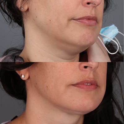 Deep Neck Lift Before & After Gallery - Patient 419933 - Image 2