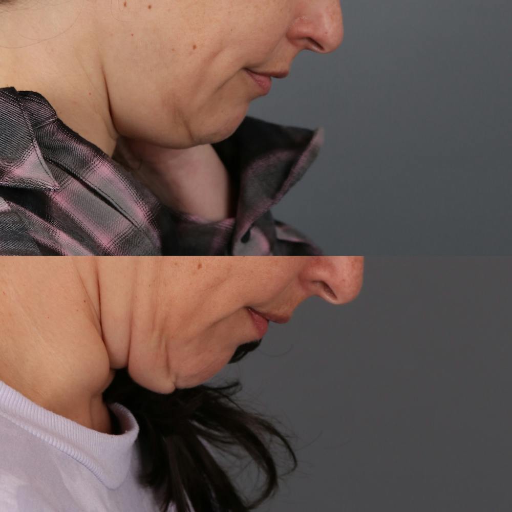 Deep Neck Lift Before & After Gallery - Patient 419933 - Image 3
