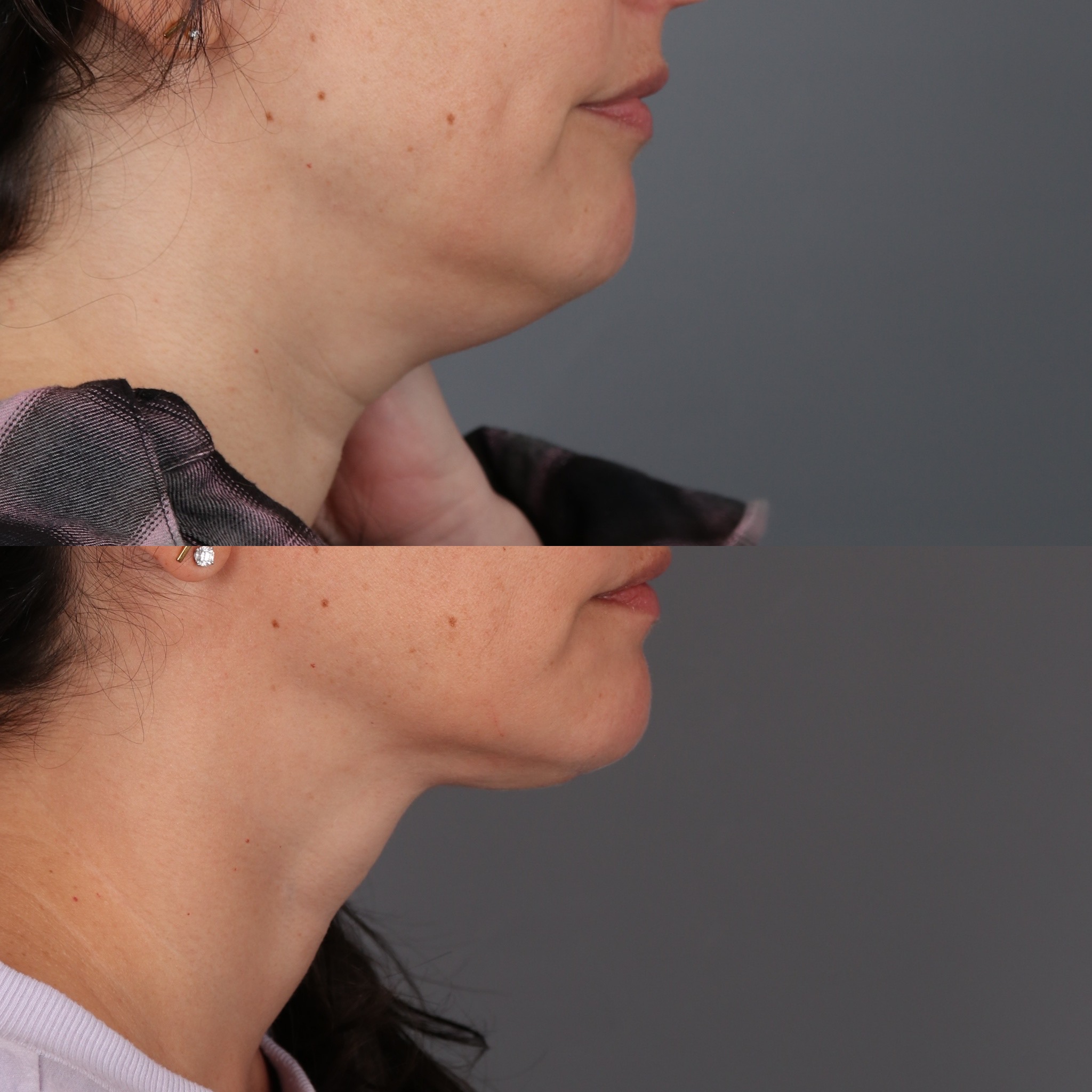 1745875136-neck-lift-side.jpg?