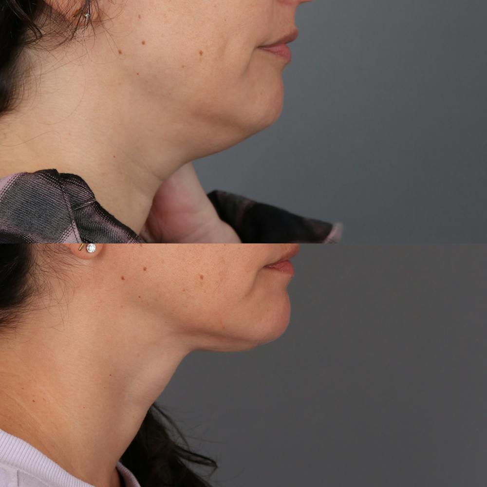 Deep Neck Lift Before & After Gallery - Patient 419933 - Image 1
