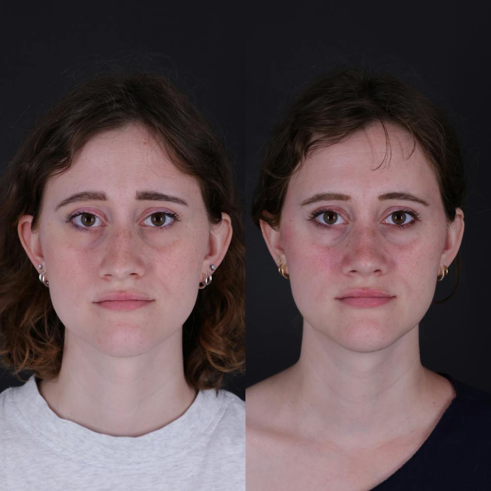 Rhinoplasty Before & After Gallery - Patient 161725 - Image 4