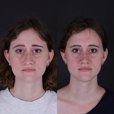Rhinoplasty Before & After Gallery - Patient 161725 - Image 4