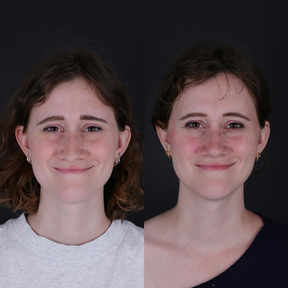 Rhinoplasty Before & After Gallery - Patient 161725 - Image 5