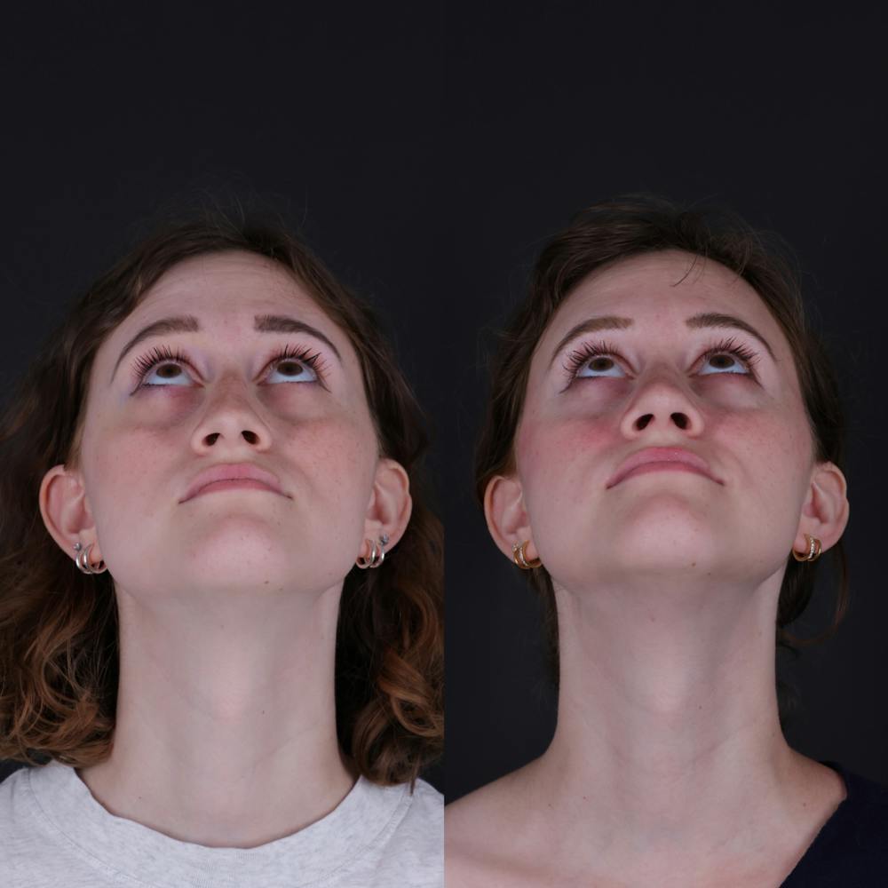 Rhinoplasty Before & After Gallery - Patient 161725 - Image 6