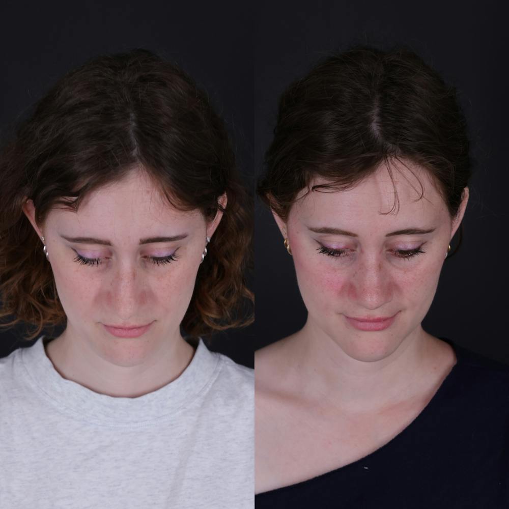 Rhinoplasty Before & After Gallery - Patient 161725 - Image 7