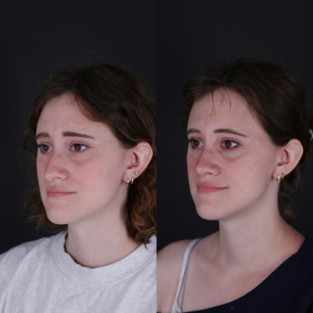 Rhinoplasty Before & After Gallery - Patient 161725 - Image 3