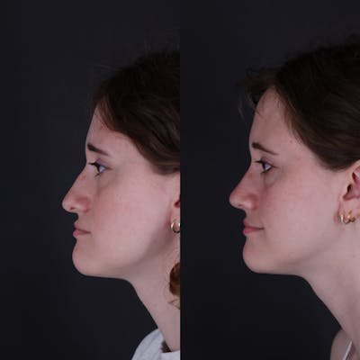 Rhinoplasty Before & After Gallery - Patient 161725 - Image 1