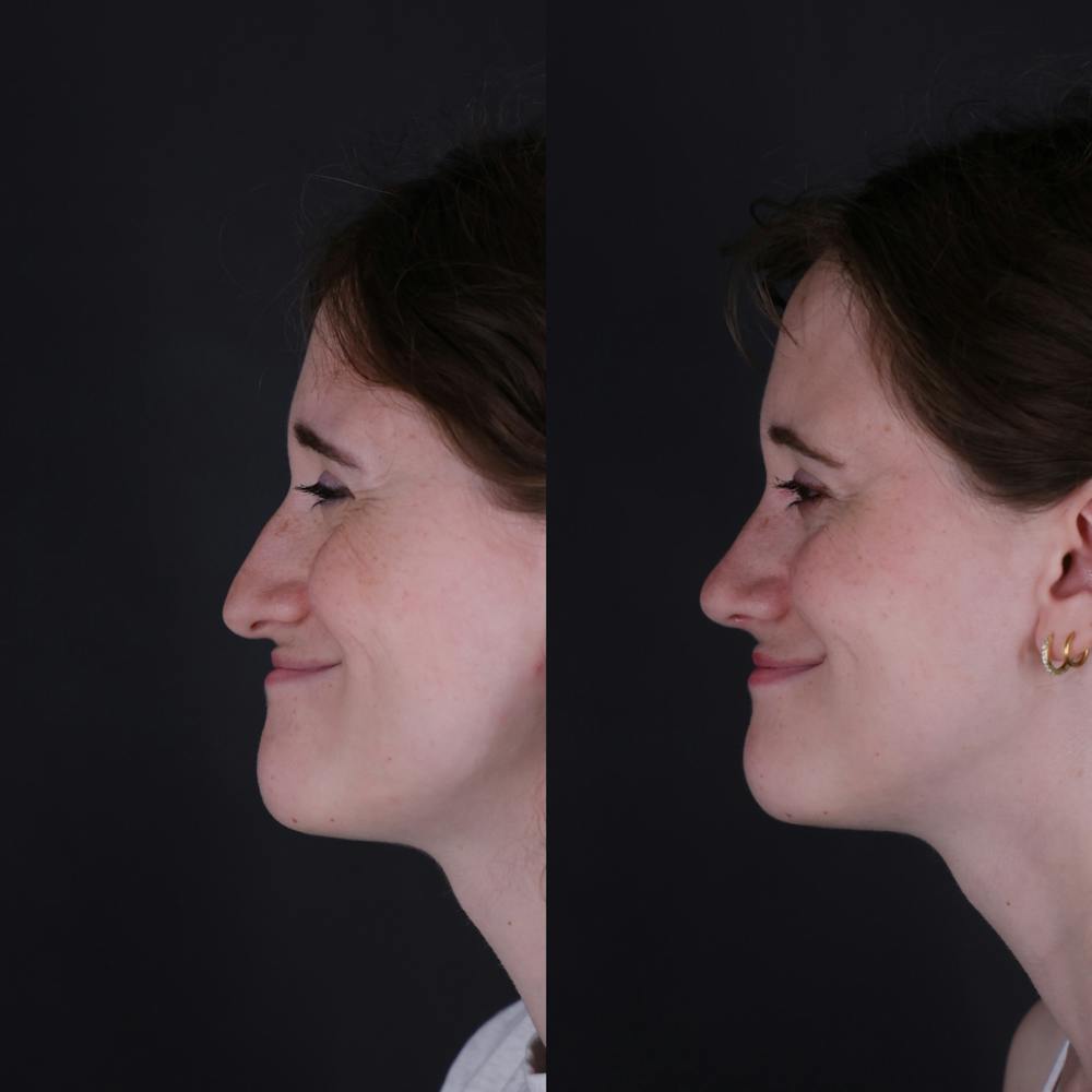 Rhinoplasty Before & After Gallery - Patient 161725 - Image 2