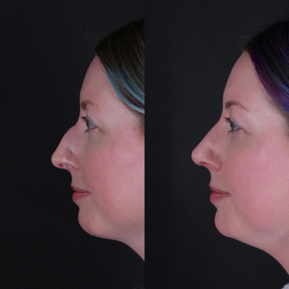 Rhinoplasty Before & After Gallery - Patient 204917 - Image 1
