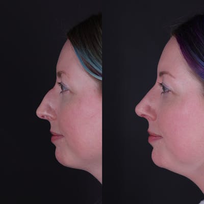 Rhinoplasty Before & After Gallery - Patient 204917 - Image 1