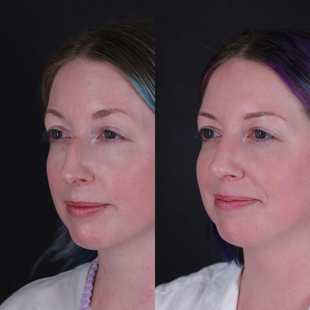 Rhinoplasty Before & After Gallery - Patient 204917 - Image 3