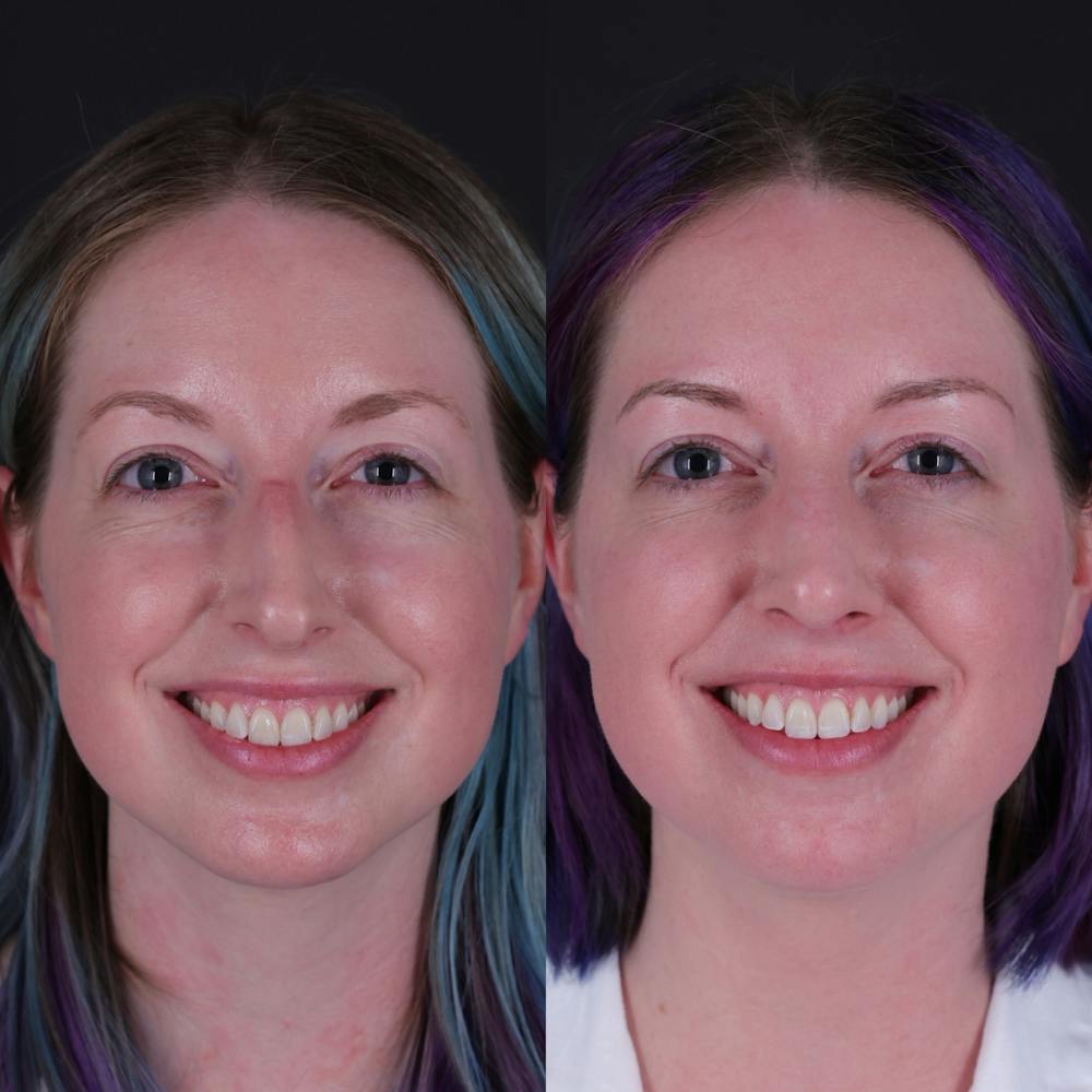 Rhinoplasty Before & After Gallery - Patient 204917 - Image 5