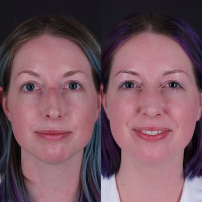 Rhinoplasty Before & After Gallery - Patient 204917 - Image 4