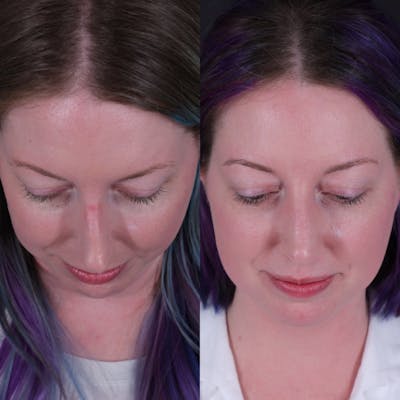 Rhinoplasty Before & After Gallery - Patient 204917 - Image 6