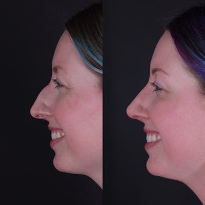 Rhinoplasty Before & After Gallery - Patient 204917 - Image 2