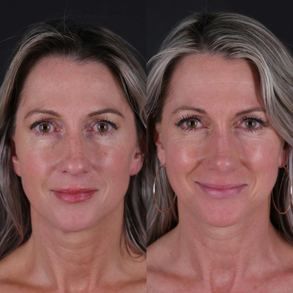 Rhinoplasty Before & After Gallery - Patient 827042 - Image 4