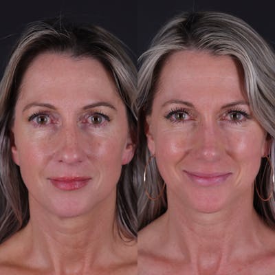 Rhinoplasty Before & After Gallery - Patient 827042 - Image 4