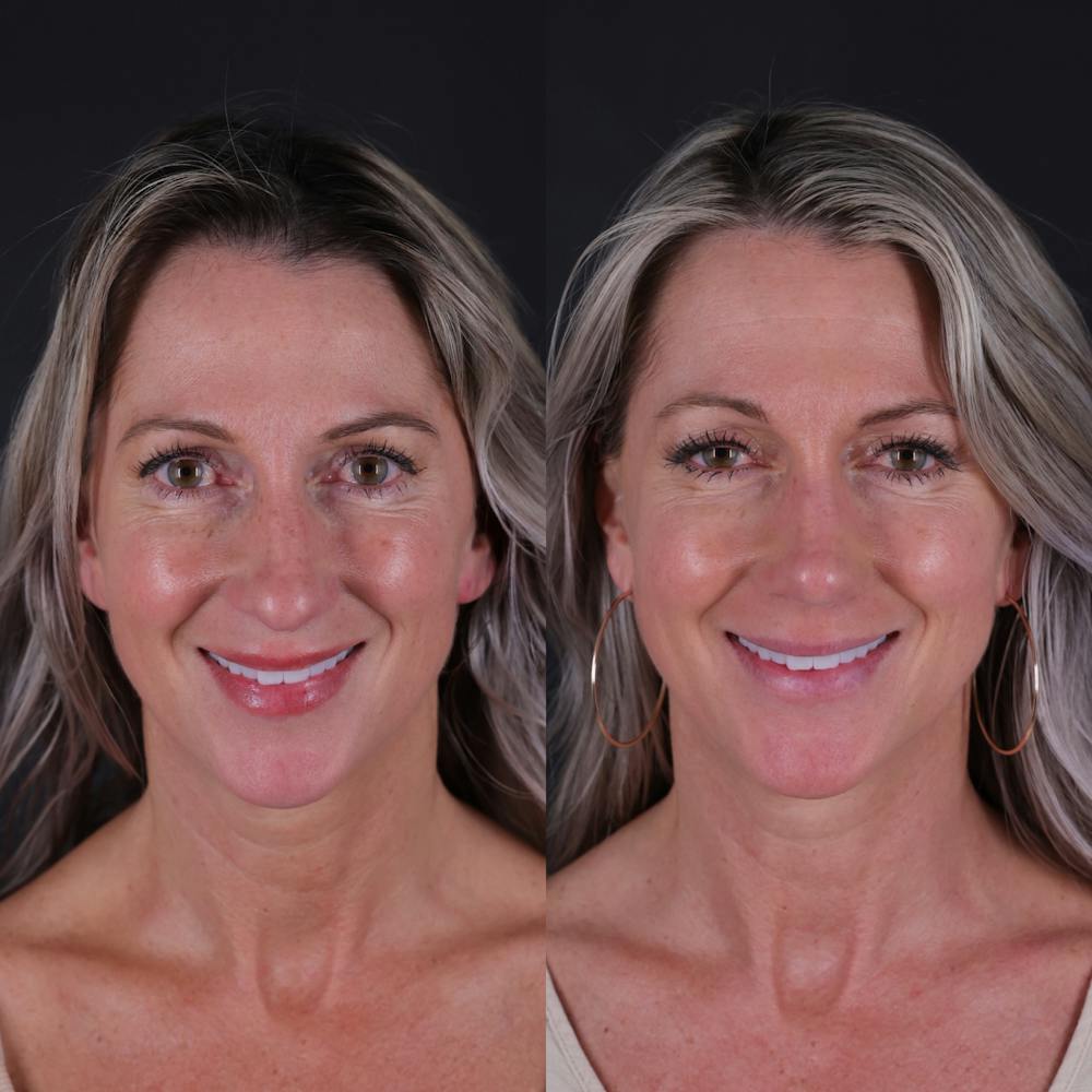 Rhinoplasty Before & After Gallery - Patient 827042 - Image 5