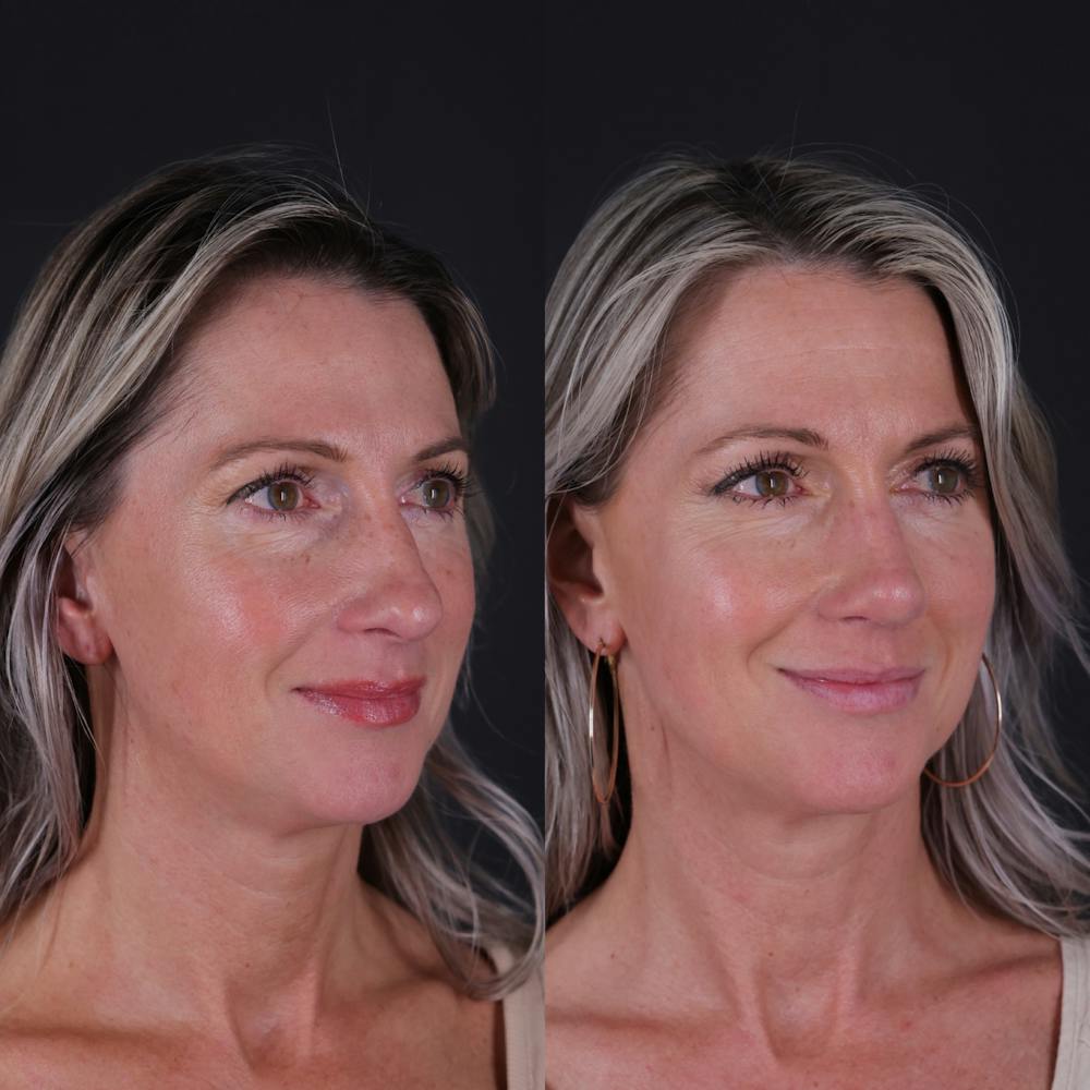 Rhinoplasty Before & After Gallery - Patient 827042 - Image 3