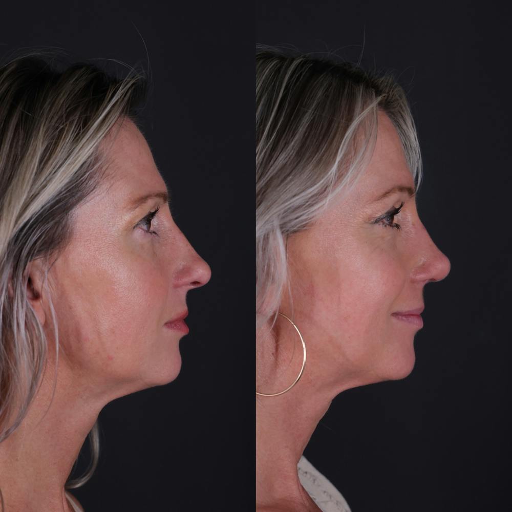 Rhinoplasty Before & After Gallery - Patient 827042 - Image 1