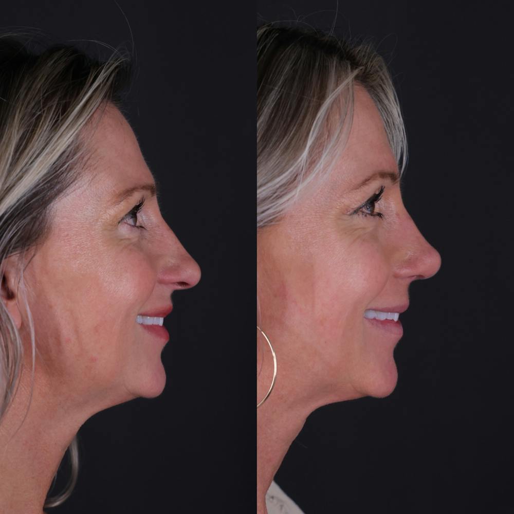 Rhinoplasty Before & After Gallery - Patient 827042 - Image 2