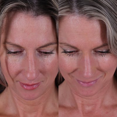 Rhinoplasty Before & After Gallery - Patient 827042 - Image 6
