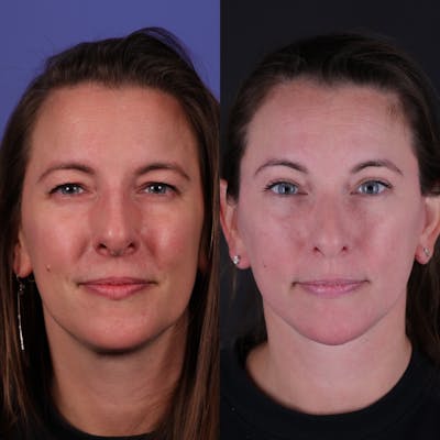 Face & Neck Lift Before & After Gallery - Patient 139584 - Image 4
