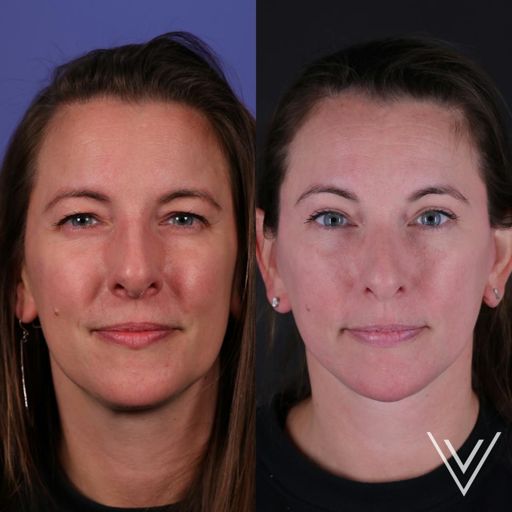 Face & Neck Lift Before & After Gallery - Patient 139584 - Image 4