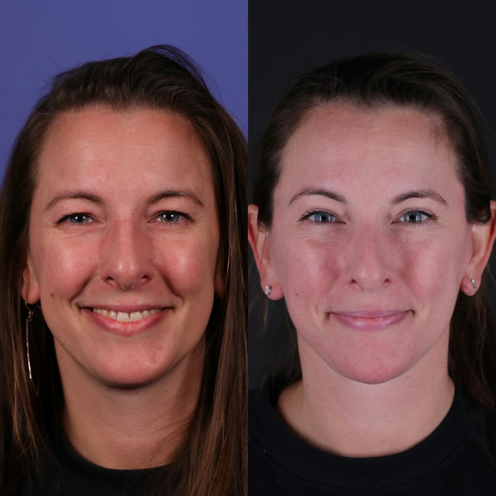 Face & Neck Lift Before & After Gallery - Patient 139584 - Image 5
