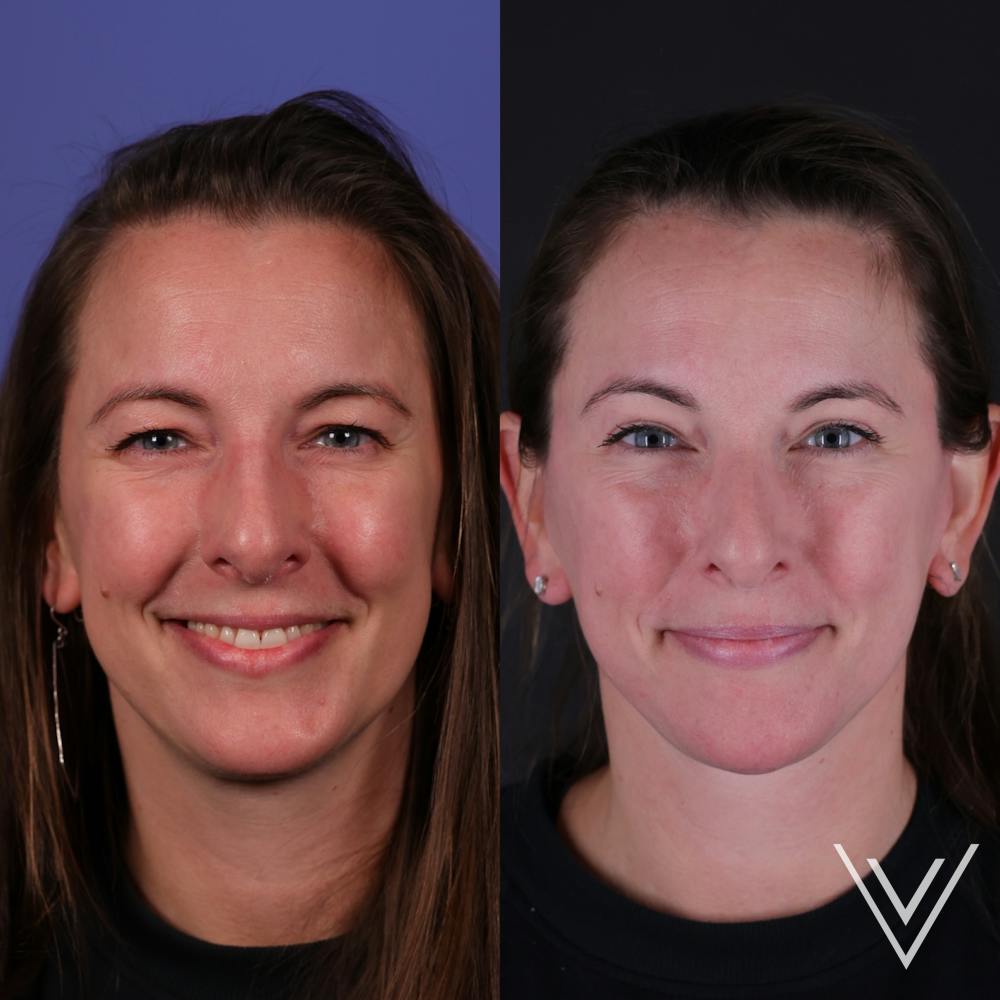 Face & Neck Lift Before & After Gallery - Patient 139584 - Image 5